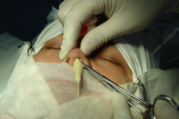 女子隆鼻术后鼻根鼓包化脓，隆鼻有何风险？(4)