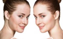 臉部經常出油的人更不健康 護理油性肌膚有妙招