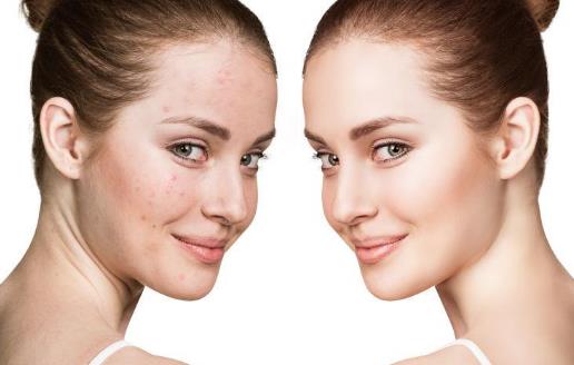 臉部經常出油的人更不健康？ 如何護理油性肌膚